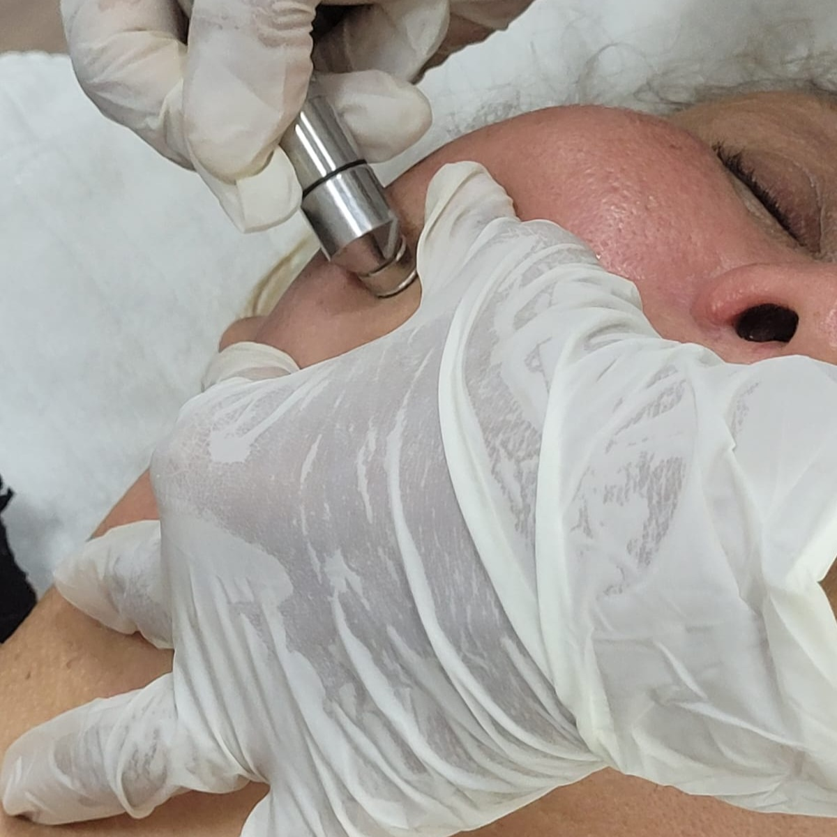 Peeling Químico e Físico thumbnail