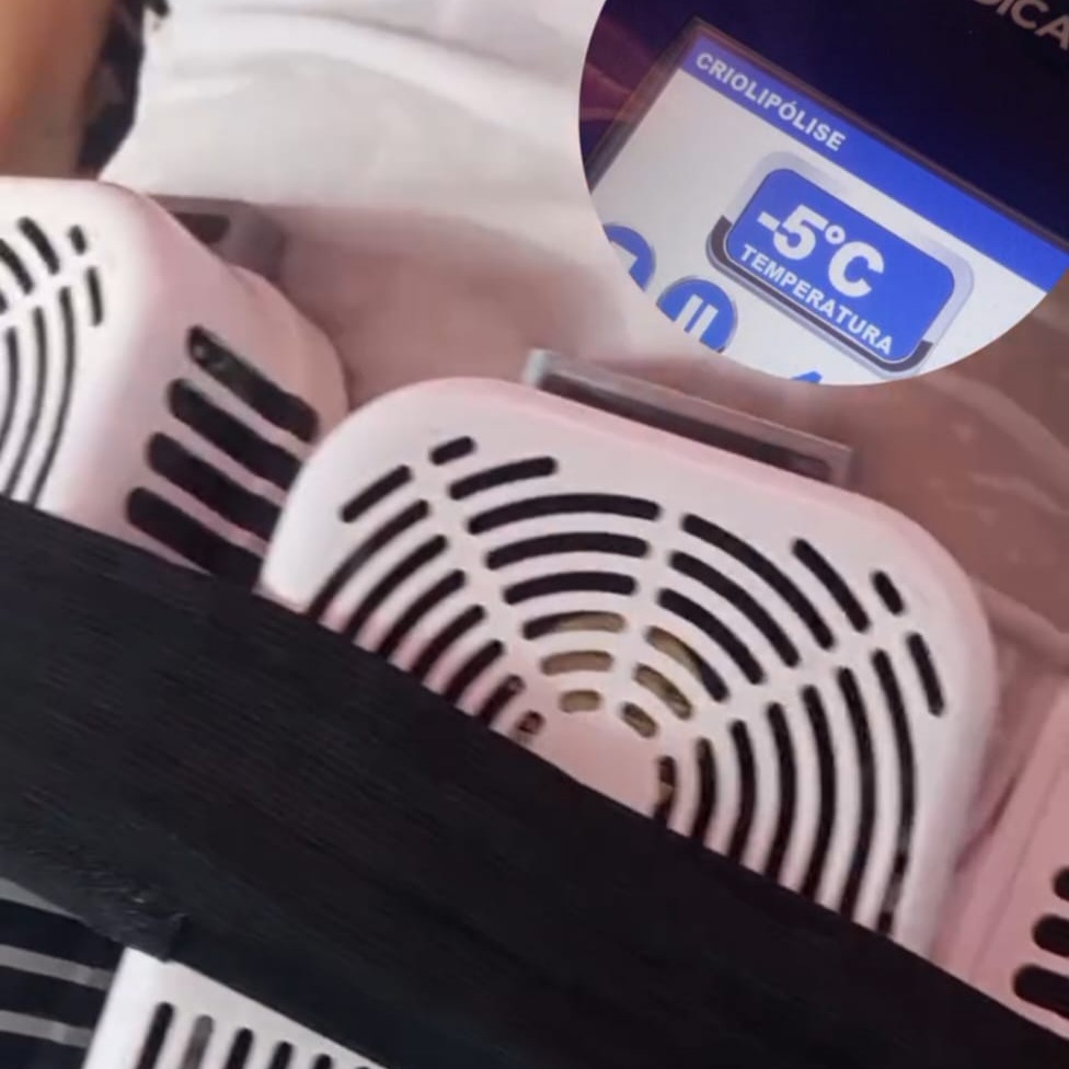 Criolipólise thumbnail