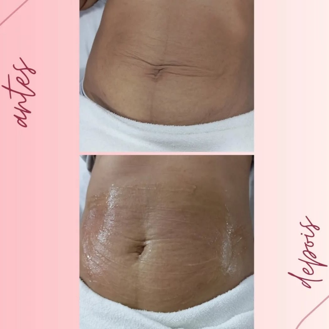 Tratamento para Flacidez thumbnail