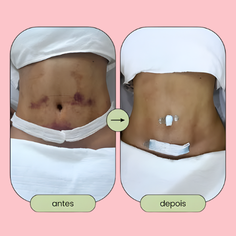 Drenagem Pós Operatório thumbnail