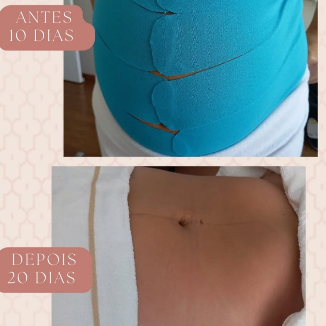 Drenagem Linfática Pós Gestação thumbnail