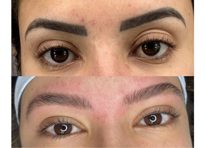 Remoção a Laser  thumbnail