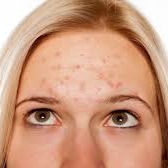 Tratamento para acne - R$120,00 thumbnail