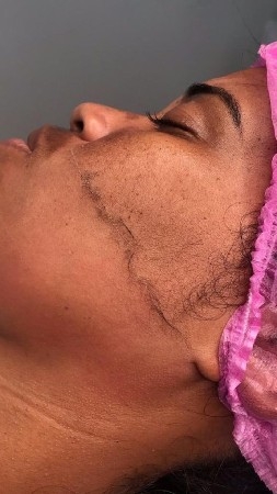 DERMAPLANING ✨️  thumbnail