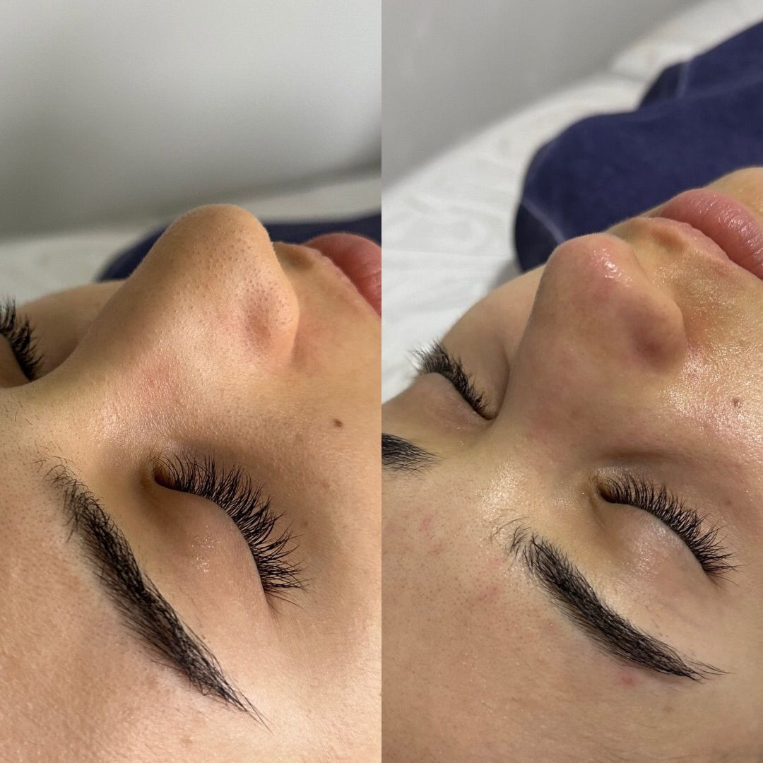 Limpeza de Pele Express  thumbnail