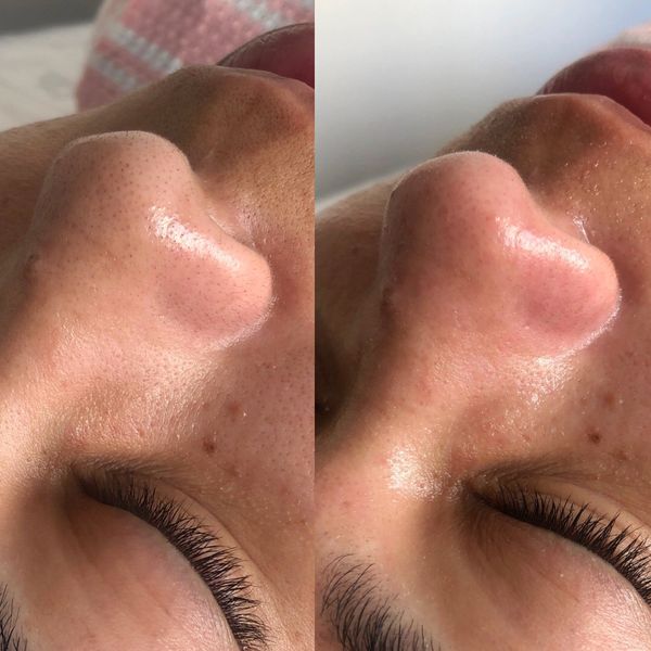 Limpeza de pele (PROFUNDA)  thumbnail