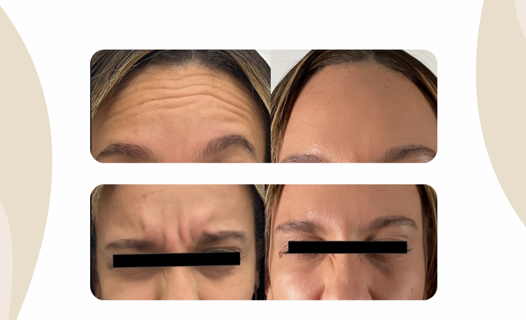 Botox Facial thumbnail