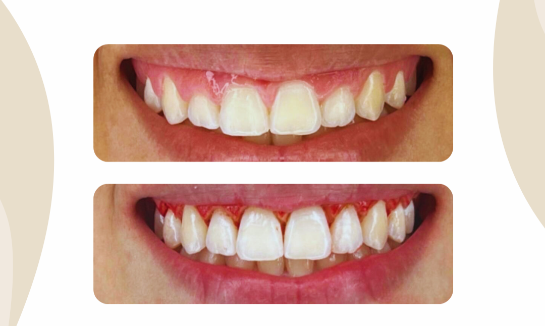 Gengivoplastia thumbnail