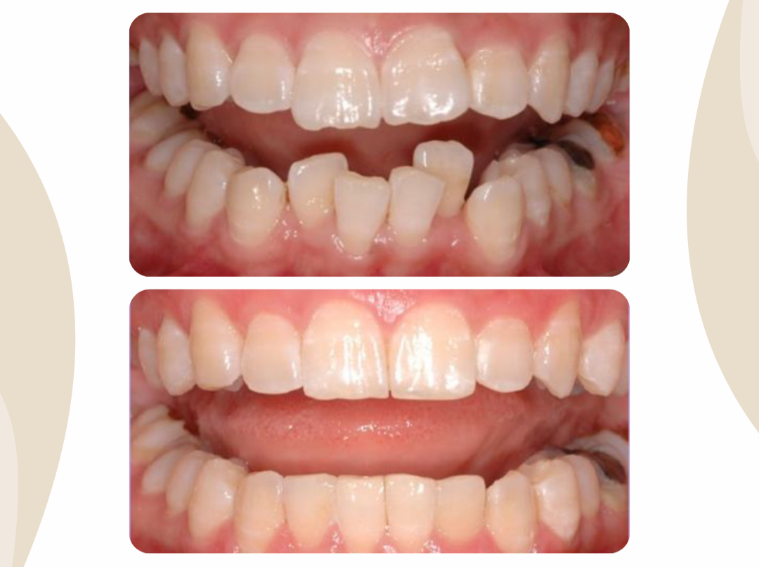 Alinhador Invisivel - 7 meses  thumbnail