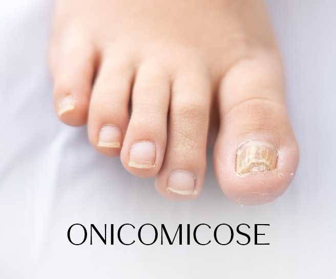 Como Tratar Onicomicose com Laser ND YAG thumbnail