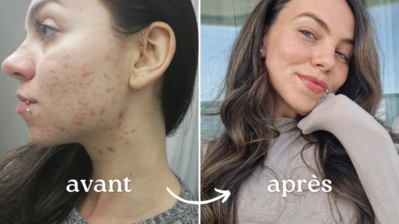 Acné hormonale : Comment je l'ai soignée 100% naturellement thumbnail