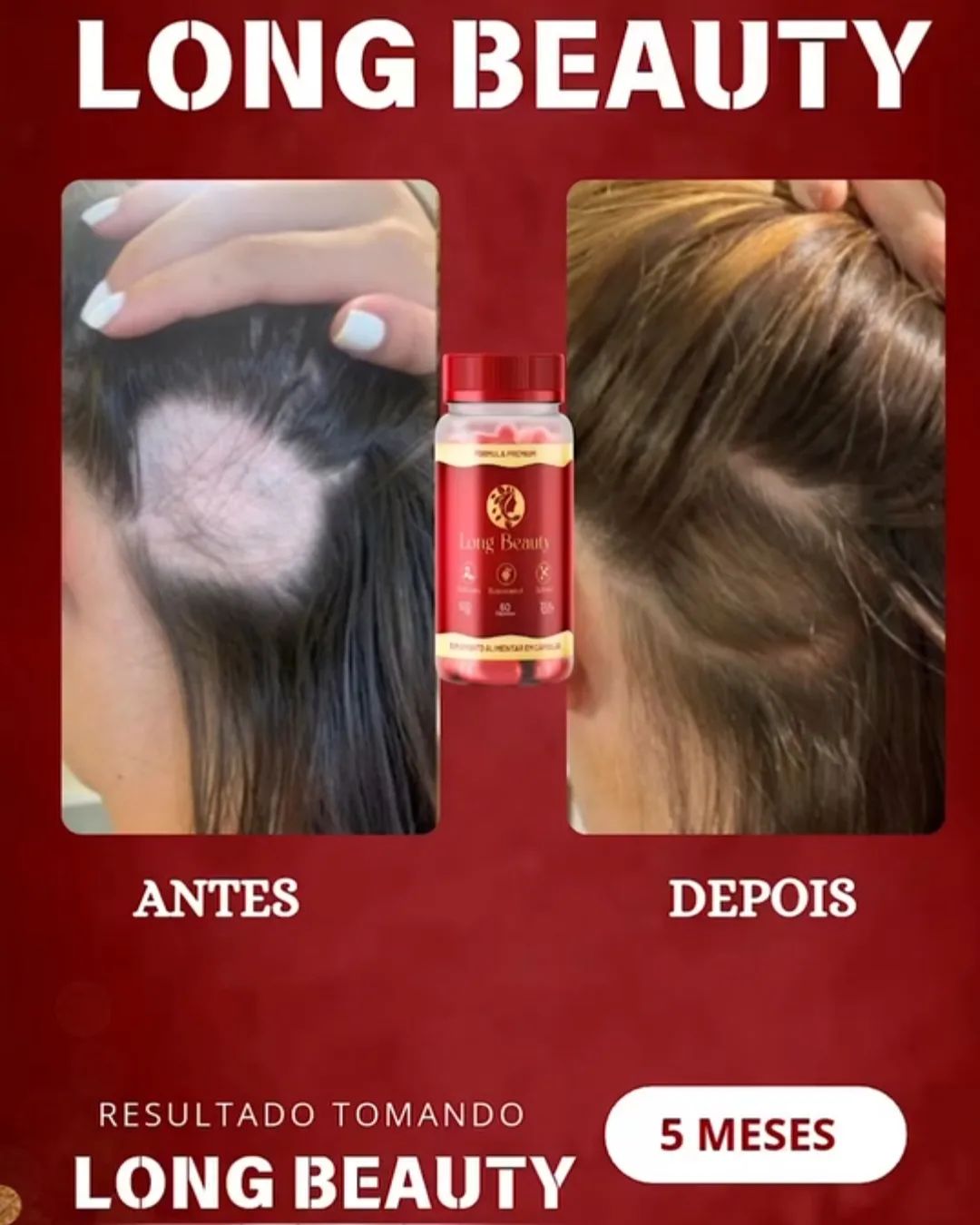 Resultado incrível em apenas 5 meses. 
Long Beauty reduz a queda capilar, contribui para a nutrição, crescimento e forta