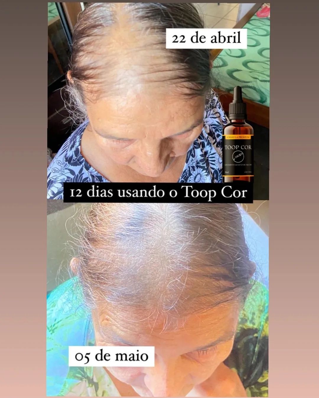 Resultado incrível em apenas 2 meses de uso! 

Com o Toop Cor isso é possível 🌟
✨ Fim dos cabelos grisalhos
✨ Fim da que