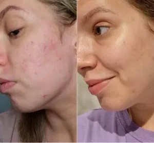 Antes / Después thumbnail