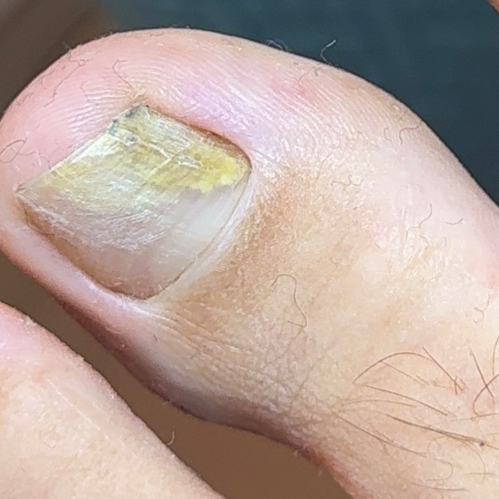 Guia Completo Doenças das unhas & Onicomicose |  Material De estudo para pedicures  thumbnail