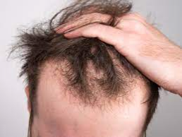 Tratamento para Queda Capilar (Eflúvio e Alopecia) thumbnail