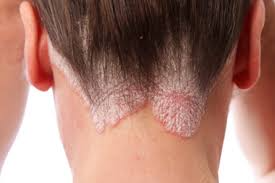Controle de Dermatites e Psoríase no Couro Cabeludo thumbnail