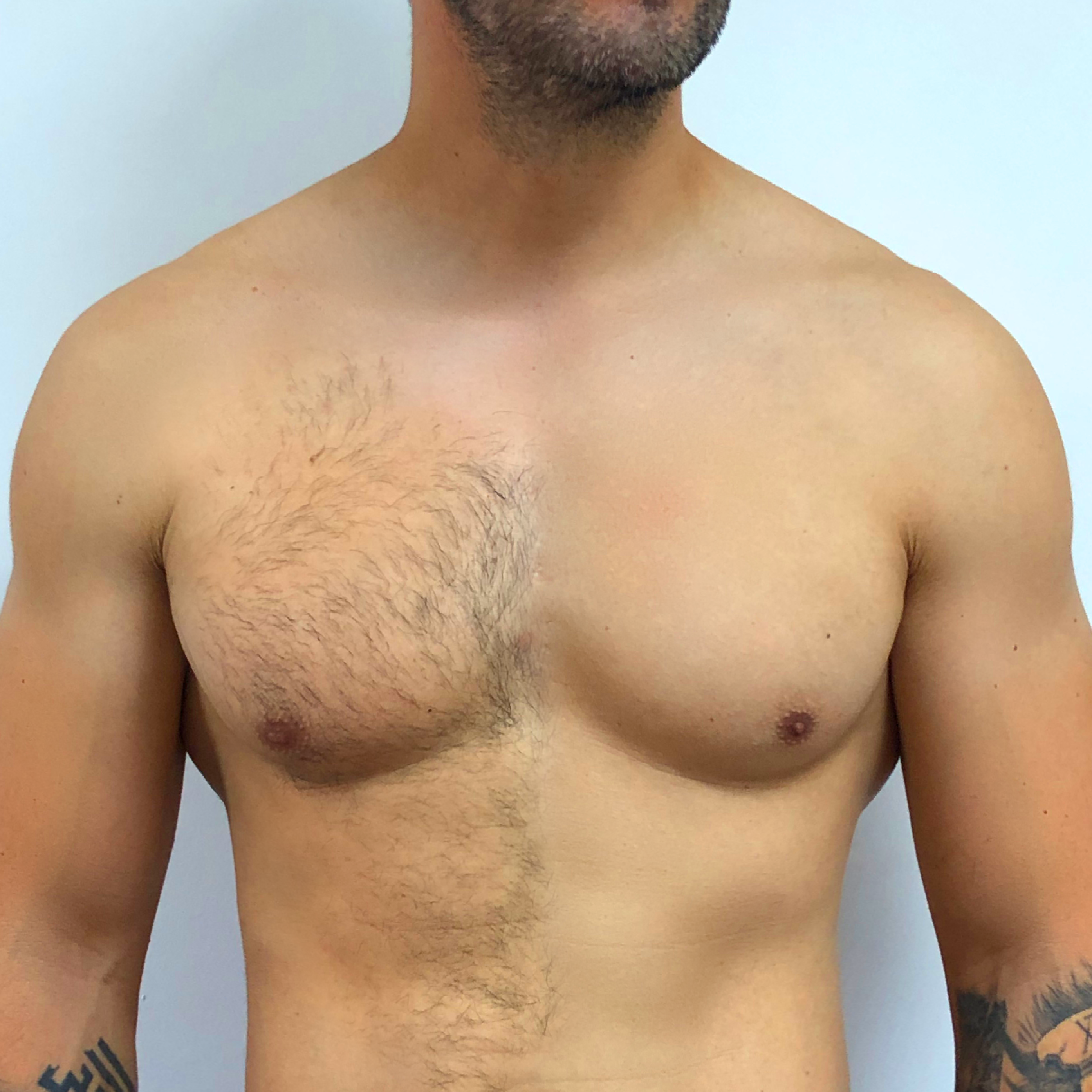 Depilación Láser Masculina (Ingresa para ver Dctos) thumbnail