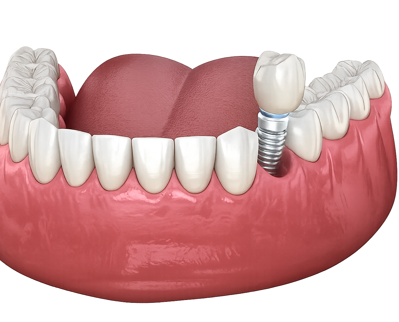 Implante Dentário - Saiba mais thumbnail