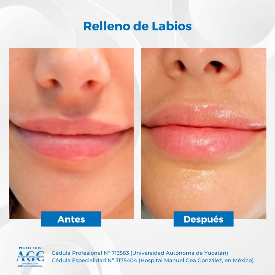Resultados extraordinarios 🙌🏻, ¿Buscas unos labios carnosos y con un aspecto natural? 👄💋 
Agenda una cita de valoración 