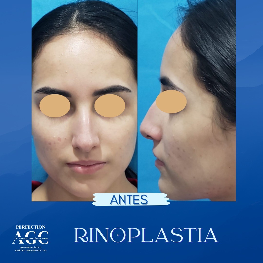 Vean este espectacular caso de Rinoplastía 👃🏼🙌🏼, ven a tu cita de valoración para que empecemos con tus resultados natur