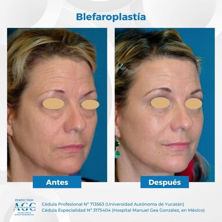 🧐👁 La blefaroplastia es un tipo de cirugía que extirpa el exceso de piel de los párpados. 

👉🏻 A medida que envejeces, l