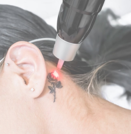 TATTOO LASER  thumbnail