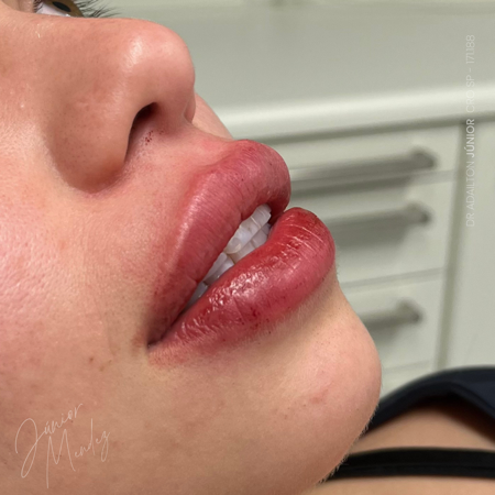 Preenchimento Labial thumbnail