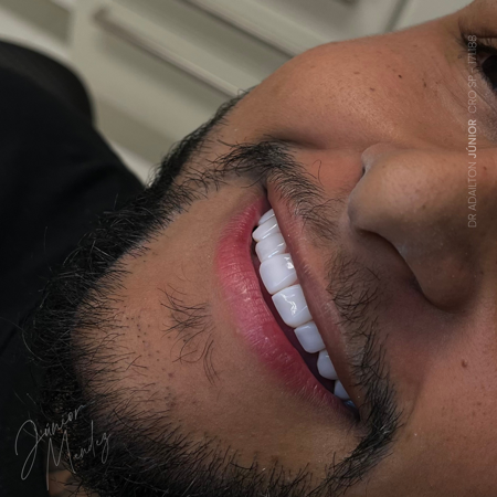 Lentes em Resina Estratificadas  thumbnail