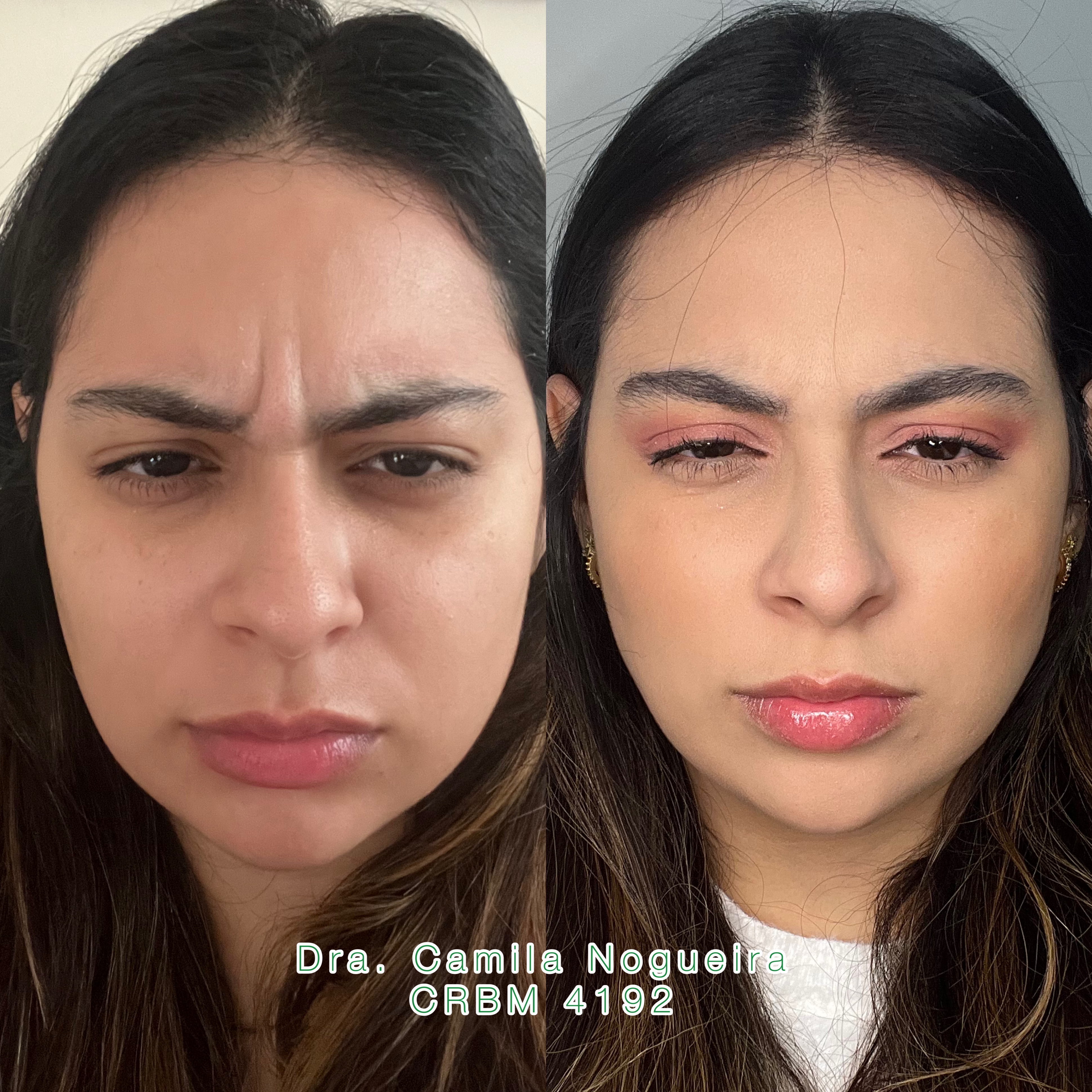 TOXINA BOTULÍNICA thumbnail
