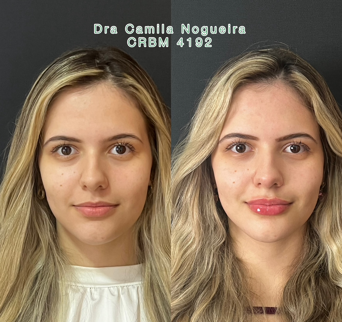PREENCHIMENTO LABIAL thumbnail