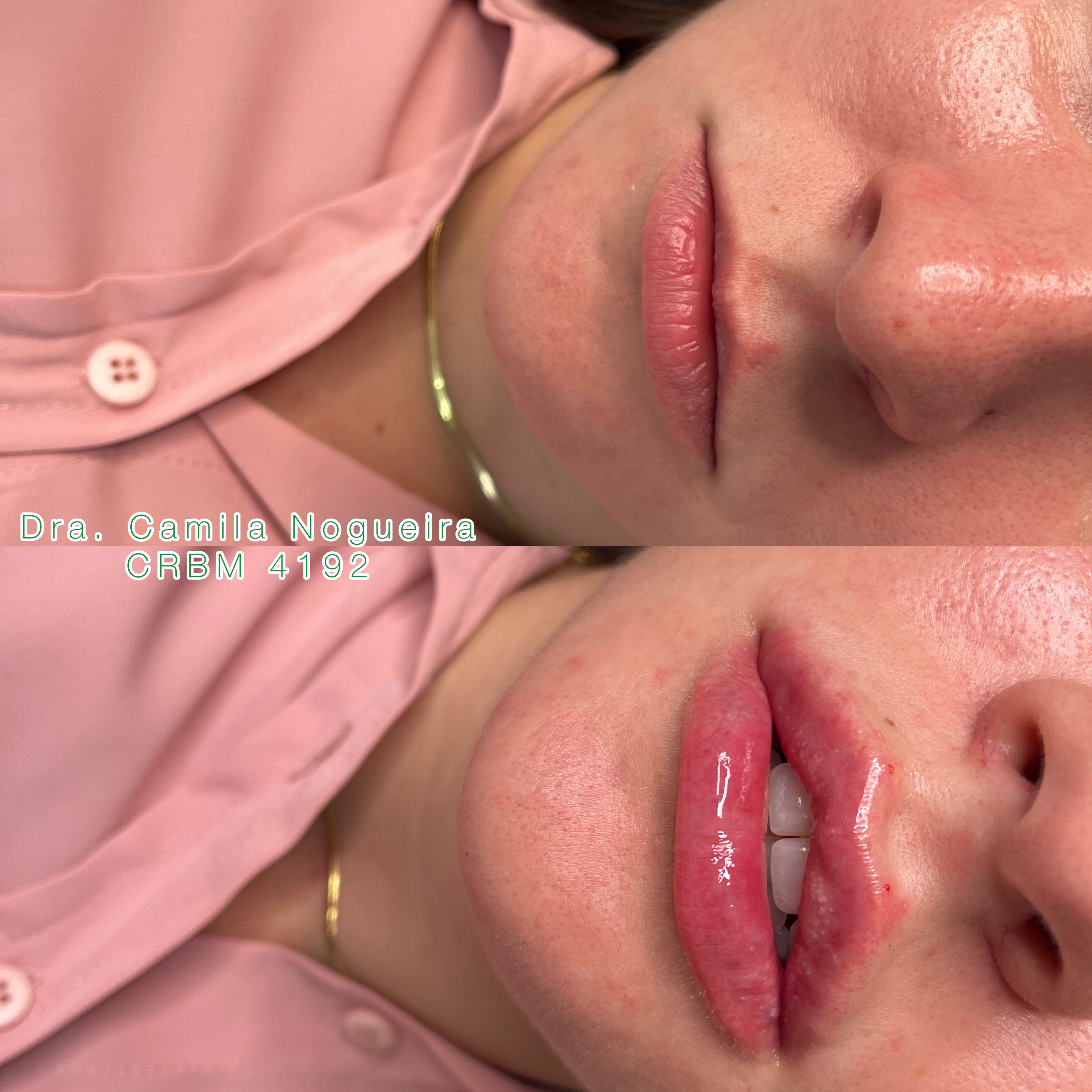 PREENCHIMENTO LABIAL thumbnail