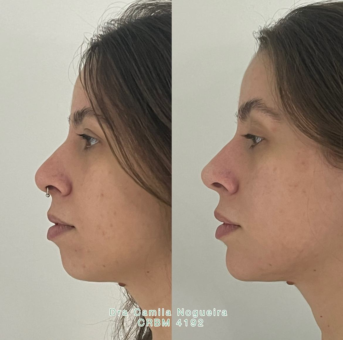 PERFILOPLASTIA NÃO CIRURGICA thumbnail