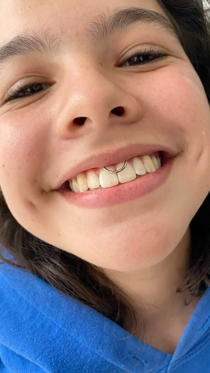 Un Smiley piercing PRECIOSOOOOO ⚡️🫧🪄