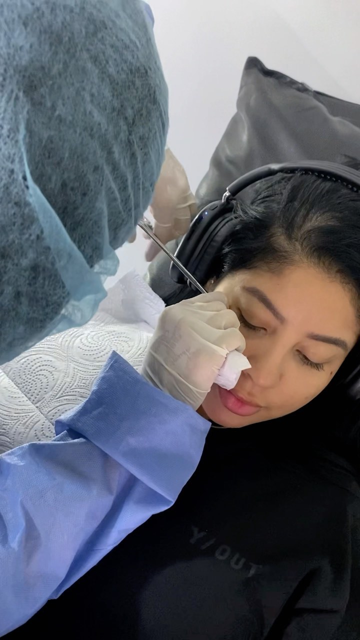 • M I C R O D E R M A L •
Un micro facial con técnica de aguja para mayor precisión.