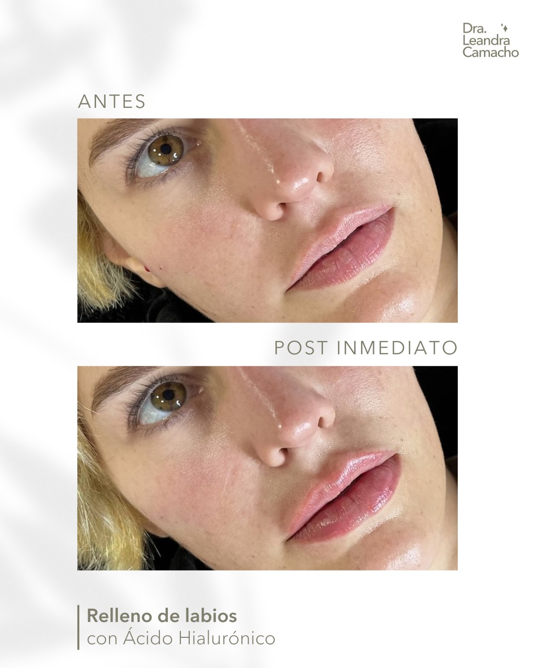 𝐄𝐦𝐛𝐞𝐥𝐥𝐞𝐜𝐢𝐦𝐢𝐞𝐧𝐭𝐨 𝐝𝐞 𝐥𝐚𝐛𝐢𝐨𝐬 𝐜𝐨𝐧 𝐚́𝐜𝐢𝐝𝐨 𝐡𝐢𝐚𝐥𝐮𝐫𝐨𝐧𝐢𝐜𝐨 💉😍

✨ Tʀᴀᴛᴀᴍɪᴇɴᴛᴏ ʀᴇᴀʟɪᴢᴀᴅᴏ ᴄᴏɴ ᴀɴᴇsᴛᴇsɪᴀ ᴛᴏ́ᴘɪᴄᴀ
✨ Rᴇsᴜʟᴛᴀᴅᴏs ɪɴᴍᴇᴅɪᴀᴛ