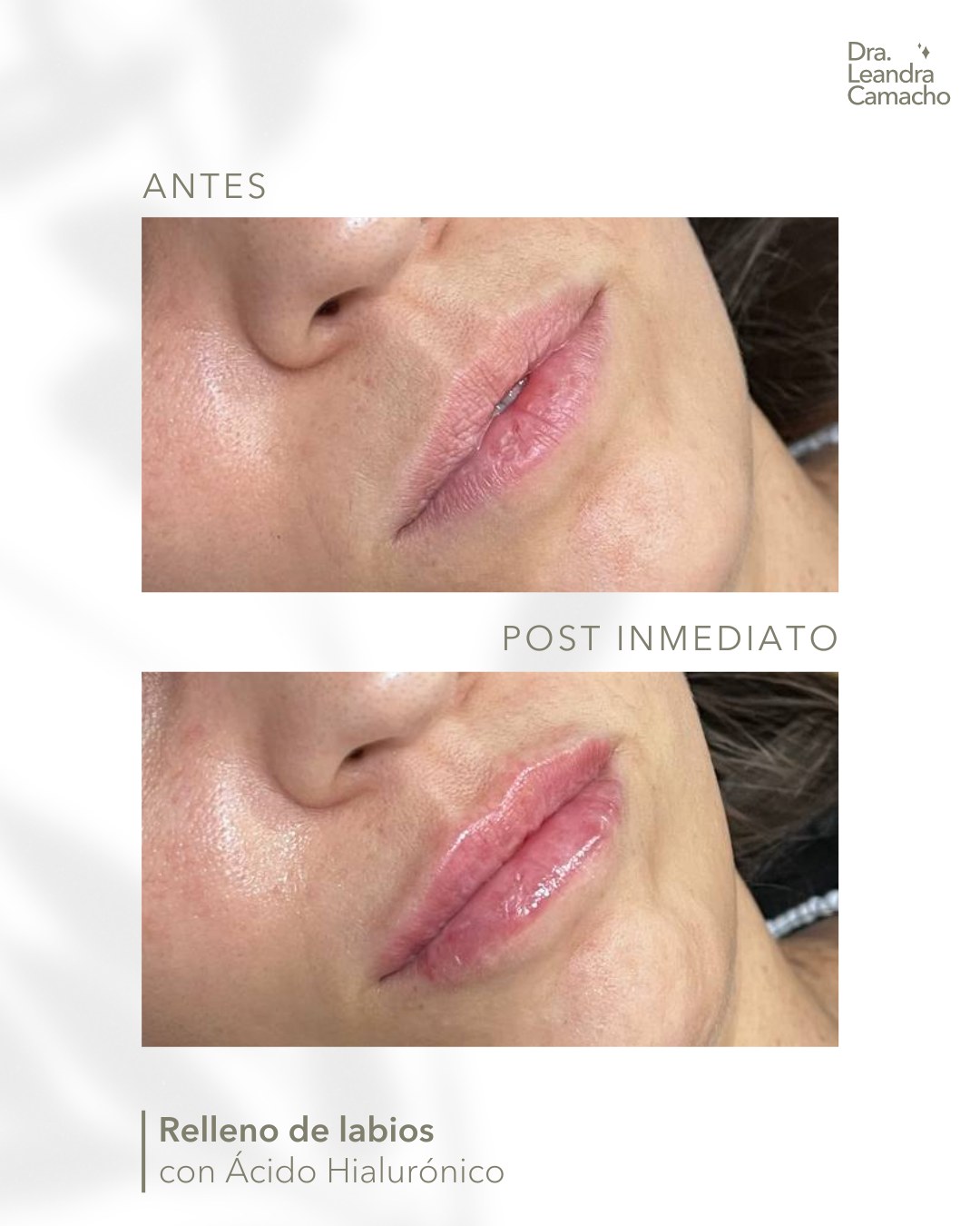 Eᴍʙᴇʟʟᴇᴄɪᴍɪᴇɴᴛᴏ ᴅᴇ ʟᴀʙɪᴏs 💉

✨ 𝐇𝐢𝐝𝐫𝐚𝐭𝐚𝐜𝐢𝐨́𝐧 
✨ 𝐃𝐞𝐟𝐢𝐧𝐢𝐜𝐢𝐨́𝐧
✨ 𝐕𝐨𝐥𝐮𝐦𝐞𝐧 
✨ 𝐍𝐚𝐭𝐮𝐫𝐚𝐥𝐢𝐝𝐚𝐝 

.
⬇️ ¿Te animás? Dejame en los com