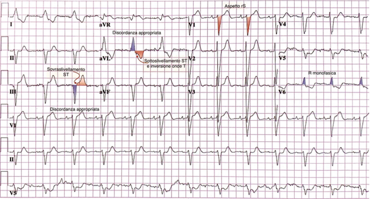 ECG: interpretazione dell'elettrocardiogramma per tutti thumbnail