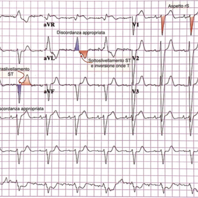 Esercitazione ECG gratuita fornita da PREPSSM - 20 minuti di videolezione e 5 casi clinici thumbnail