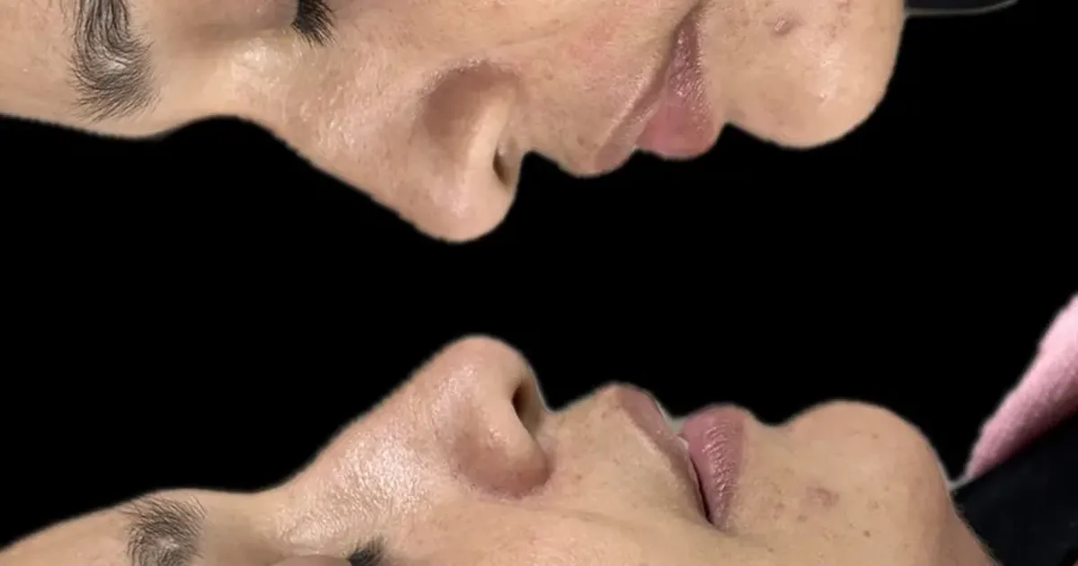 Dominando a Lipo de Papada (LIPOESCULTURA CERVICAL) com Maestr thumbnail