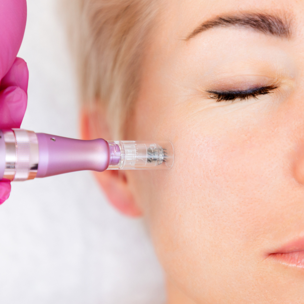 Microagulhamento  thumbnail