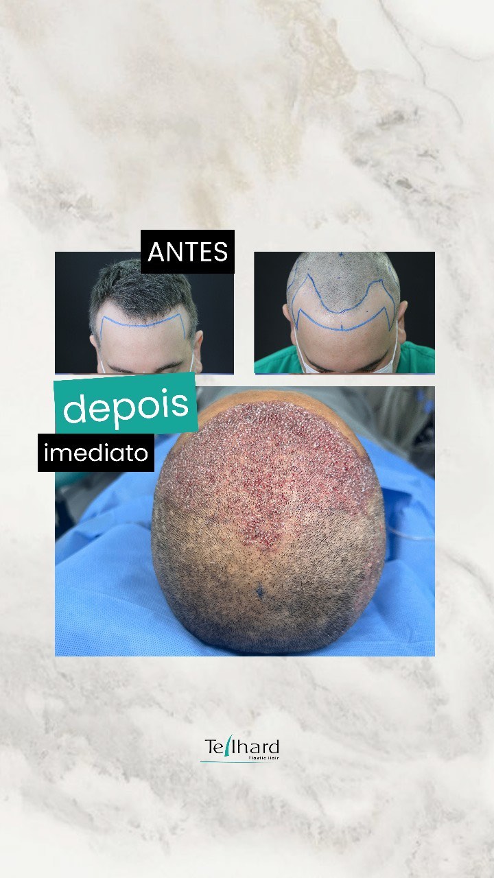 Compartilhando o antes e depois da cirurgia de hoje aqui no Hospital Clínica Teilhard Plastic Hair. A transformação é no