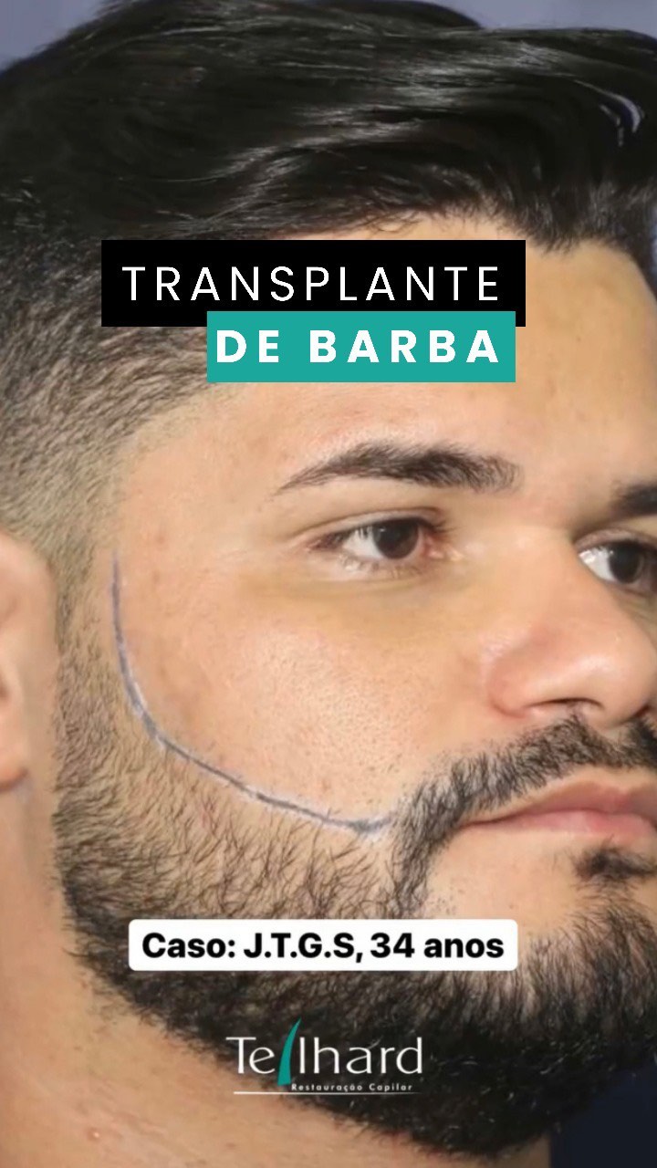 VOCÊ SABIA? 🤷🏻‍♂️
O Transplante de Barba é similar ao de cabelo.

✅ O paciente tem alta no mesmo dia e pode retomar suas