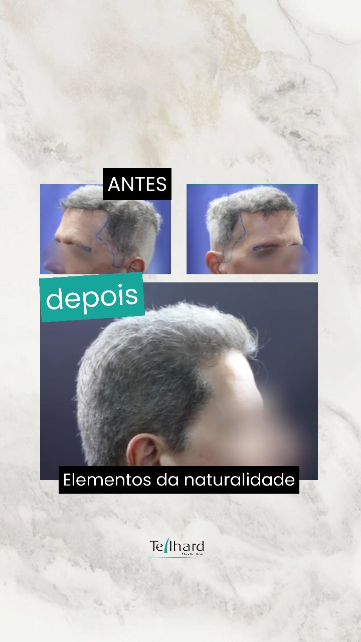 Transplante Capilar em outras regiões:

- Recesso Temporal
- Costeleta
- Sobrancelha

#transplantecapilar #recife #cabel