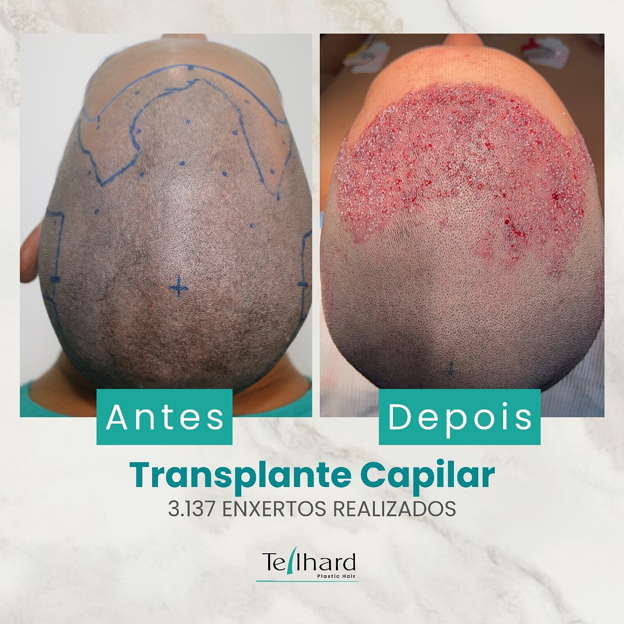 Rumo a transformação capilar! No dia 25.01.2024, realizamos um transplante com 3.137 enxertos para elevar a densidade ca