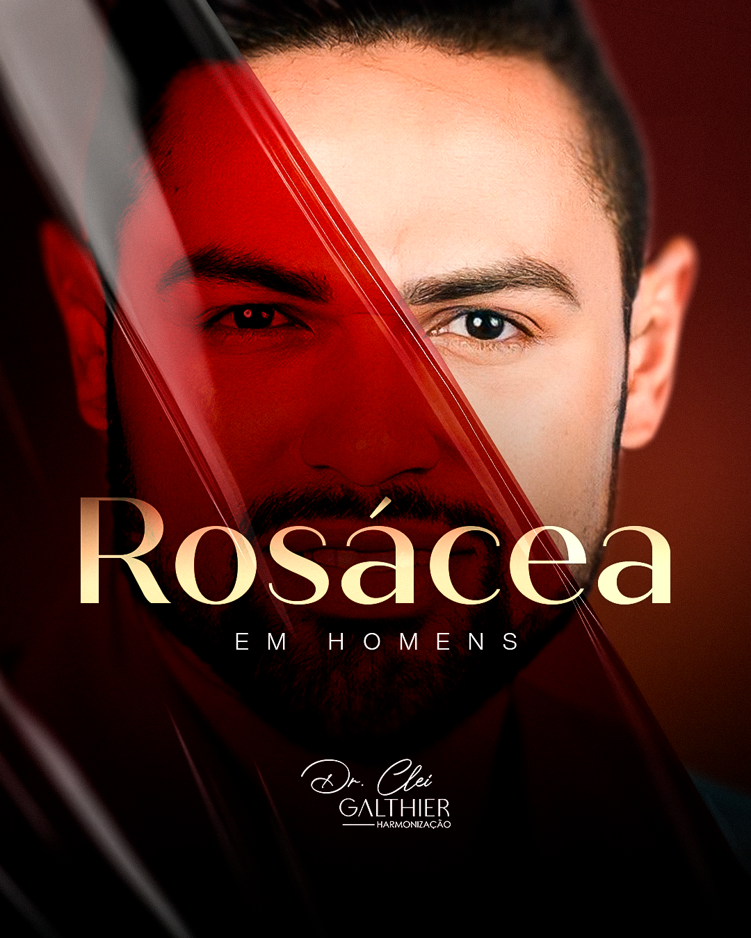 Rosácea I Dr. Clei Galthier®️ thumbnail