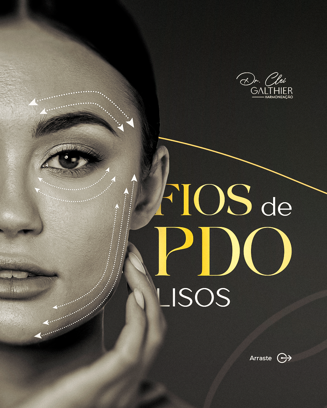 Fios de Sustentação I Dr. Clei Galthier®️ thumbnail