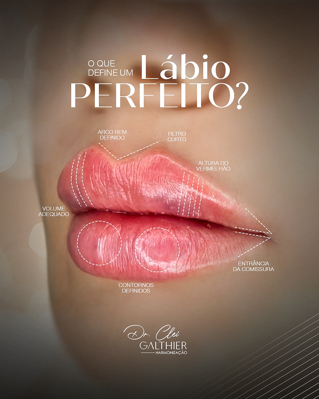 Preenchimento Labial  I Dr. Clei Galthier®️ thumbnail