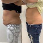 TOP Fat Reduction thumbnail