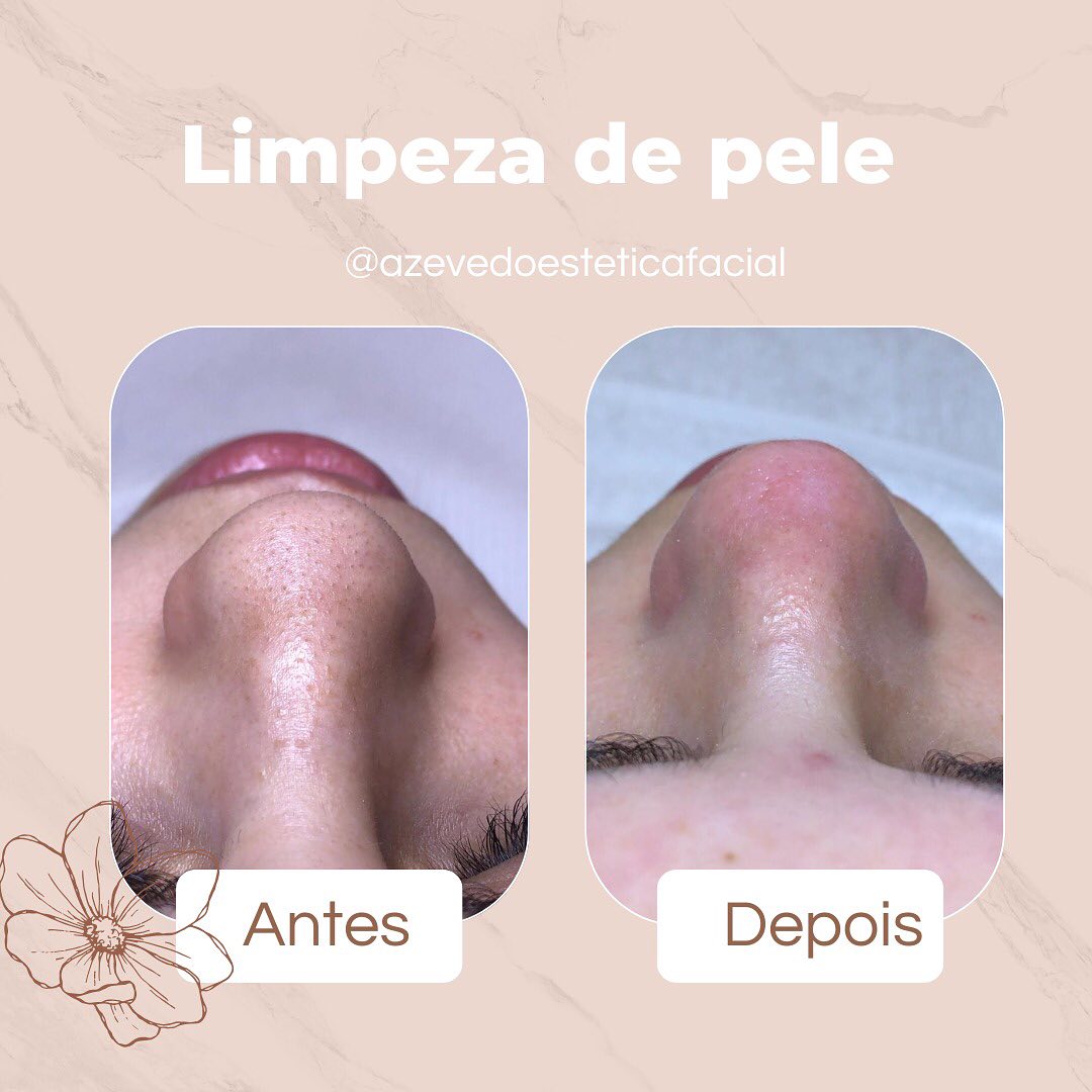 🌸 Limpeza de pele completa: resultados que transformam! 🌸

Olha só a diferença! ✨ A limpeza de pele faz toda a diferença